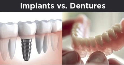 dental implant vs dentures