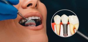 dental implants 